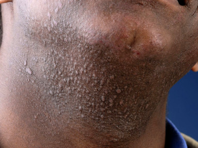Pseudofolliculitis barbae
