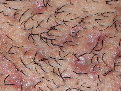 Pseudofolliculitis barbae