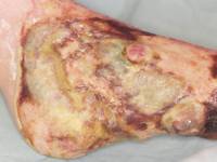 Pseudomonas in ulcus cruris