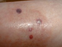 Ecthyma gangrenosum door Pseudomonas sepsis