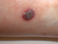 Ecthyma gangrenosum door Pseudomonas sepsis