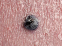 Pseudotumor van Masson