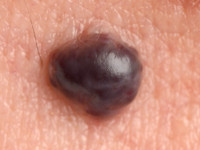 Pseudotumor van Masson