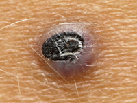 Pseudotumor van Masson