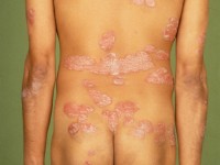 Psoriasis vulgaris, common psoriasis