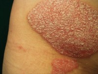 Psoriasis vulgaris, common psoriasis