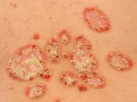 Psoriasis vulgaris, common psoriasis