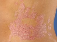 Psoriasis vulgaris, common psoriasis