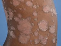 Psoriasis vulgaris, common psoriasis