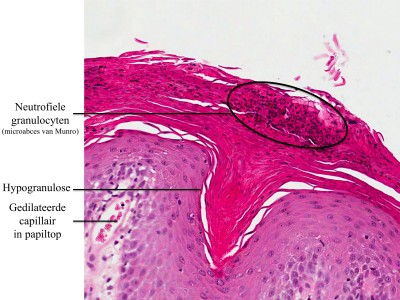 Psoriasis, histologisch beeld