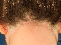 Psoriasis capitis (psoriasis of the scalp)