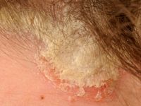 Psoriasis capitis (psoriasis of the scalp)