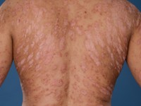Psoriasis in dennenboom configuratie