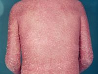 Erythroderma based on psoriasis