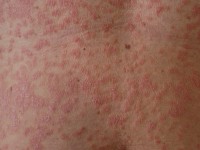 Guttate psoriasis