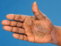 psoriasis van de handpalmen