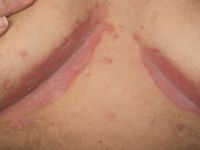 Psoriasis inversa