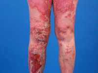 Psoriasis pustulosa generalisata Zumbusch