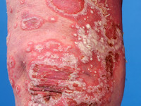 Psoriasis pustulosa generalisata Zumbusch