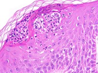 Psoriasis pustulosa generalisata Zumbusch