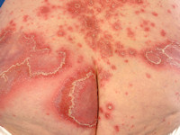 pustular psoriasis generalisata