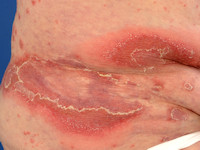 Psoriasis pustulosa generalisata Zumbusch