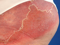 pustular psoriasis generalisata