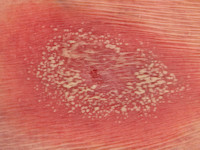 pustular psoriasis generalisata