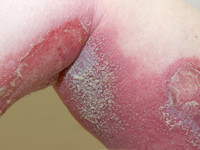 Psoriasis pustulosa generalisata Zumbusch