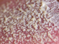 Psoriasis pustulosa generalisata Zumbusch