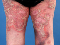 Psoriasis pustulosa generalisata Zumbusch