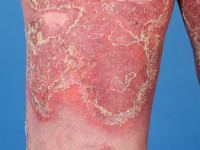 Psoriasis pustulosa generalisata Zumbusch
