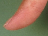 Pulp loss (spitse vingertoppen)