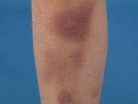 Auto-imuun trombocytopenische purpura