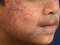 Purpura t.g.v. plotselinge intravasculaire drukverhoging