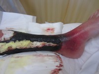 Purpura fulminans door proteine S deficientie