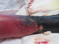 Purpura fulminans door proteine S deficientie