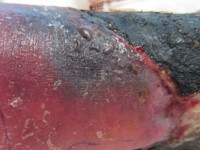 Purpura fulminans door proteine S deficientie