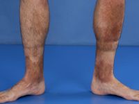 Purpura pigmentosa progressiva