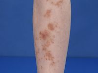 Purpura pigmentosa progressiva