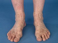 Purpura pigmentosa progressiva