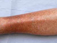 Purpura pigmentosa progressiva