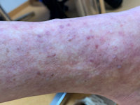 Purpura pigmentosa lichenoides (Goucherot-Blum)