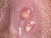 metastatic Crohn disease