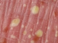 Pustulosis palmoplantaris