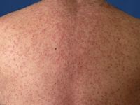 Pustuleuze toxicodermie 