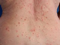 Pustuleuze toxicodermie 