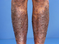 Amicrobial pustulosis bij SLE