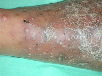 Pustulosis