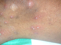 Pustulosis